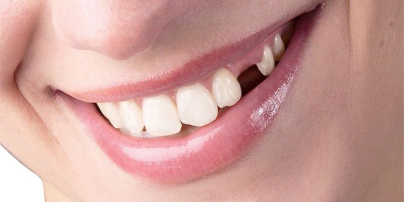 Mơ Thấy Rụng Răng Đánh Gì? Jun88 Hé Lộ Bộ Số Vàng 2025 5 Mơ rụng răng một chiếc nhưng tiền bạc chảy về như suối